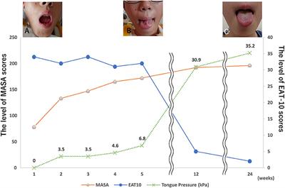 Isolated bilateral hypoglossal nerve paralysis following an atlanto-occipital dislocation: A case report